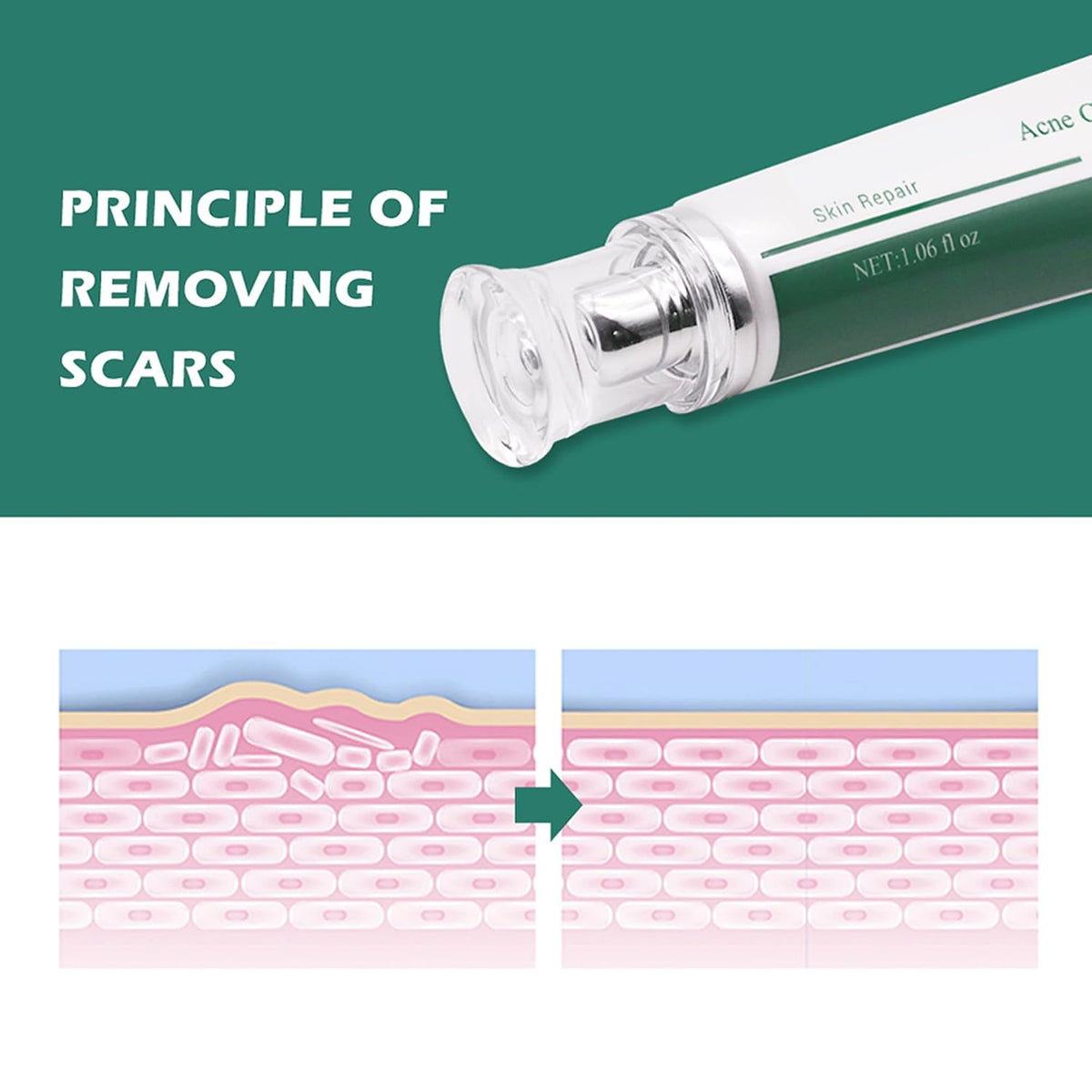 Scar Cream, Face Pimples Scar Stretch Marks Cream Moisturizing Repair Damaged Skin Gel Scar Treatment
