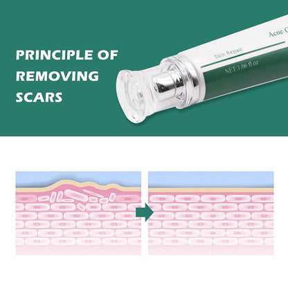 Scar Cream, Face Pimples Scar Stretch Marks Cream Moisturizing Repair Damaged Skin Gel Scar Treatment