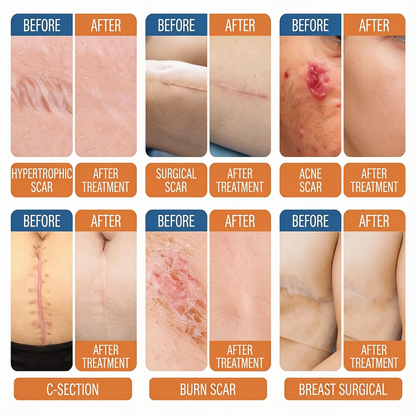 Silicone Scar Sheets, Medical Grade Silicone Scar Tape for Old & New Scars